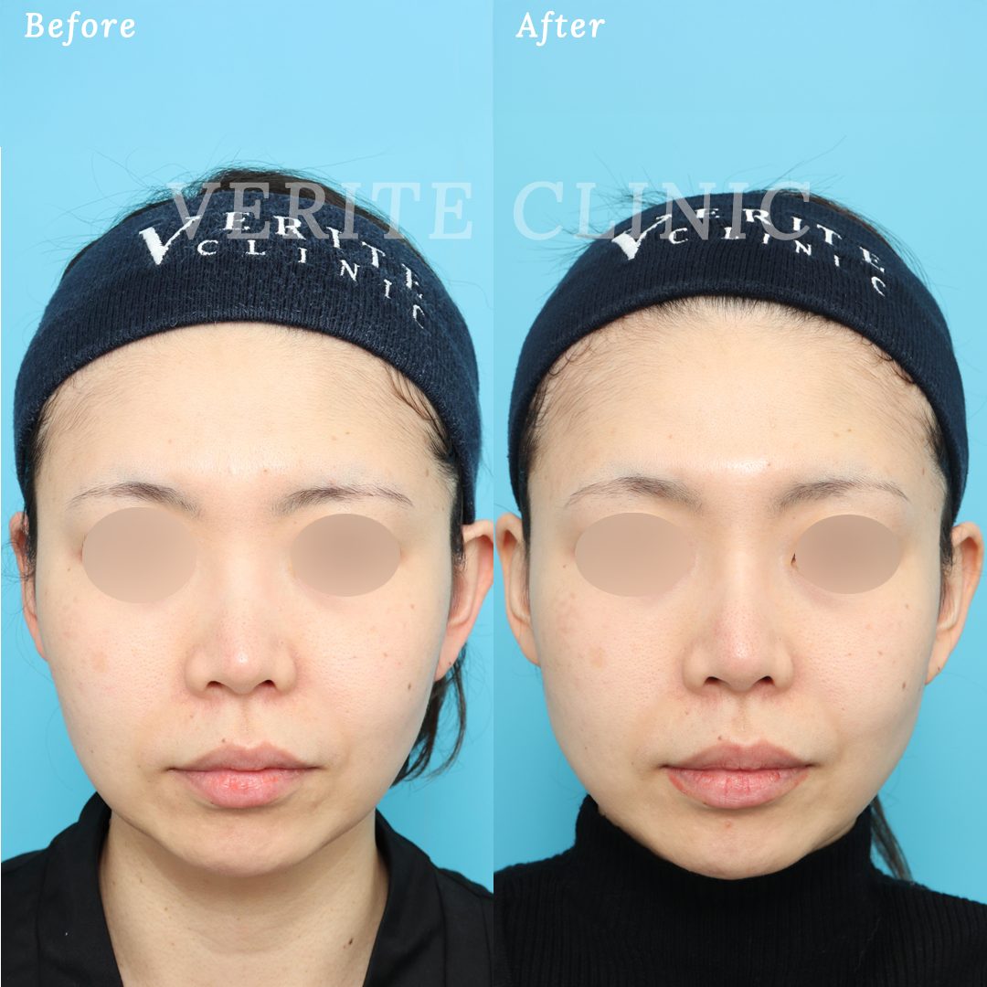隆鼻術＋眉間プロテーゼの症例写真