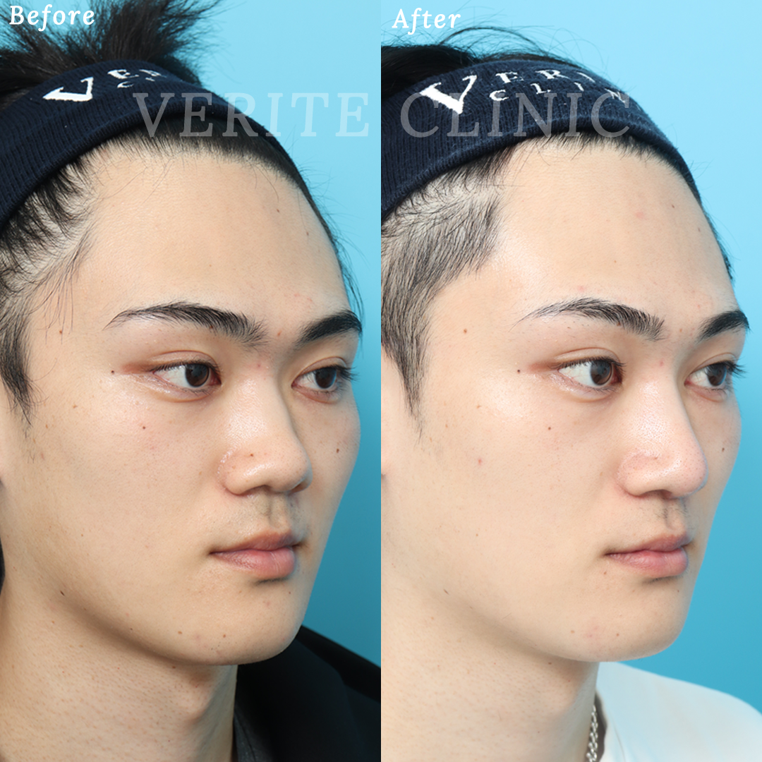 隆鼻術＋眉間プロテーゼの症例写真