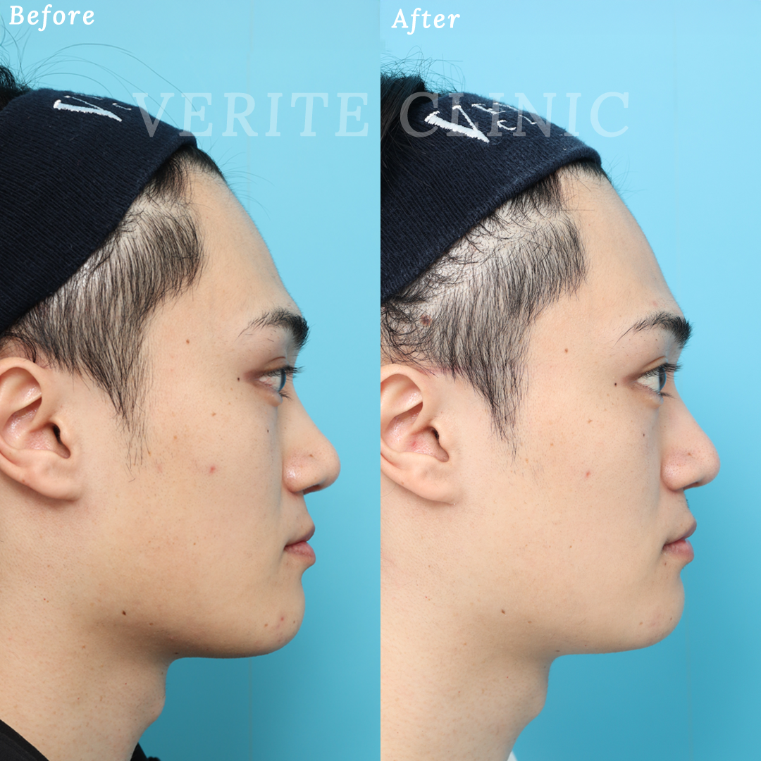 隆鼻術＋眉間プロテーゼの症例写真 (2) - サムネイル