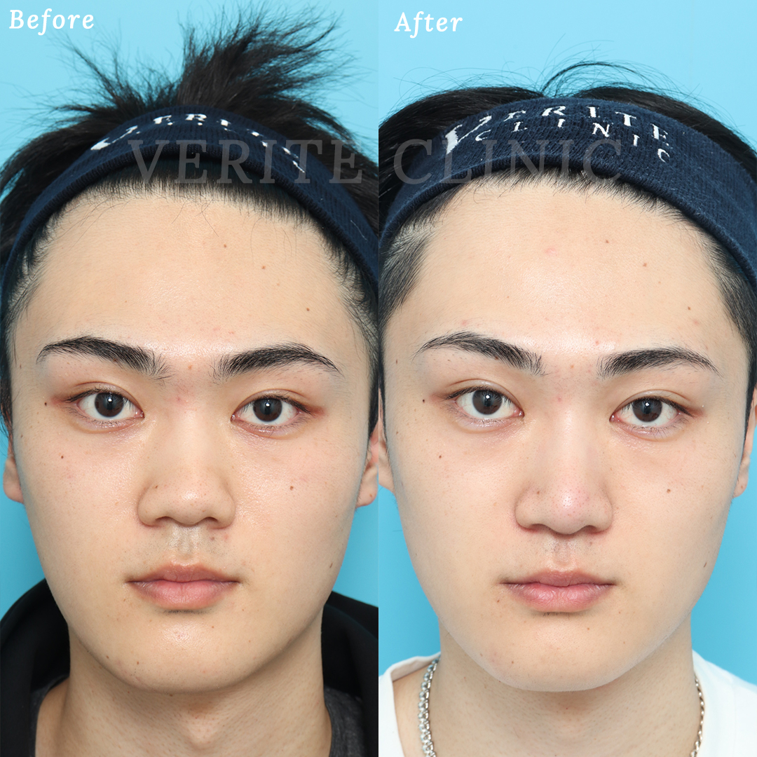 隆鼻術＋眉間プロテーゼの症例写真 (3) - サムネイル