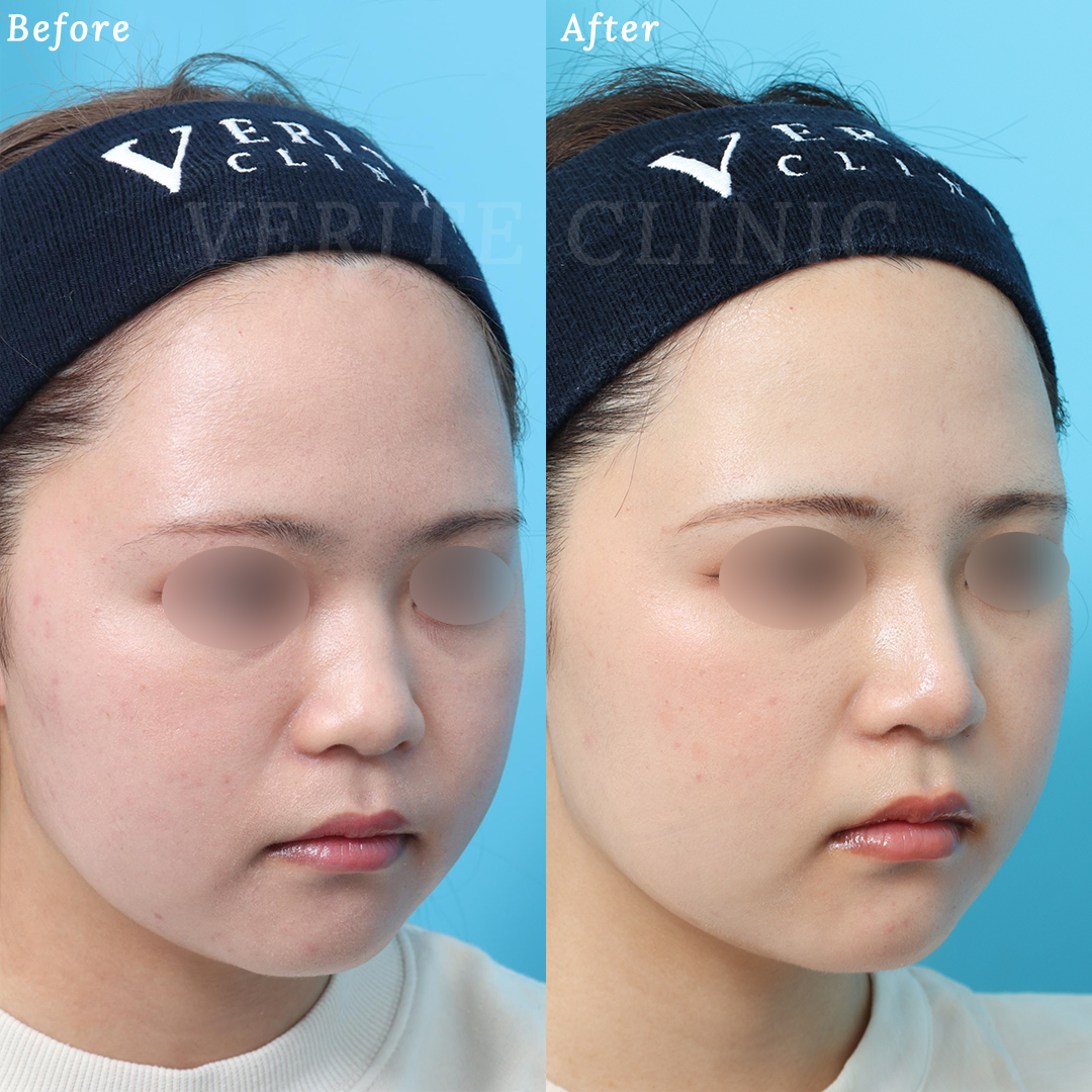 隆鼻術＋眉間プロテーゼの症例写真 (1) - サムネイル