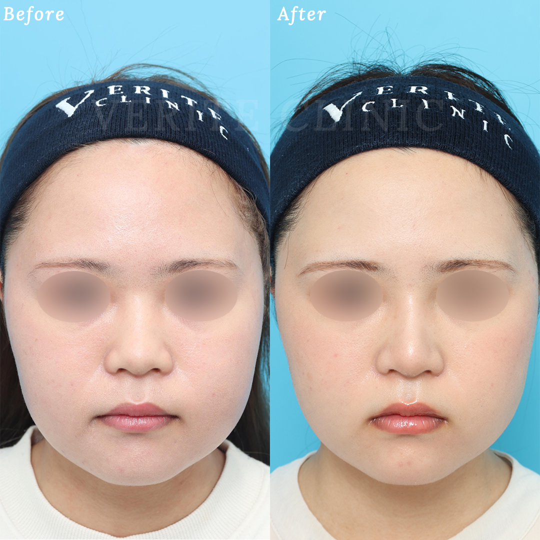 隆鼻術＋眉間プロテーゼの症例写真 (2) - サムネイル