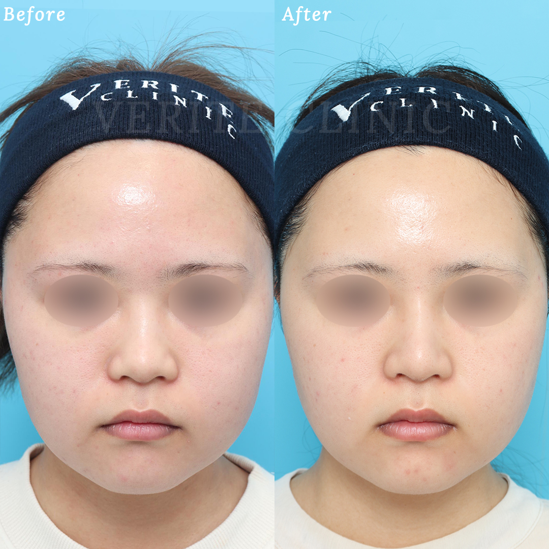 隆鼻術＋眉間プロテーゼの症例写真 (5) - サムネイル