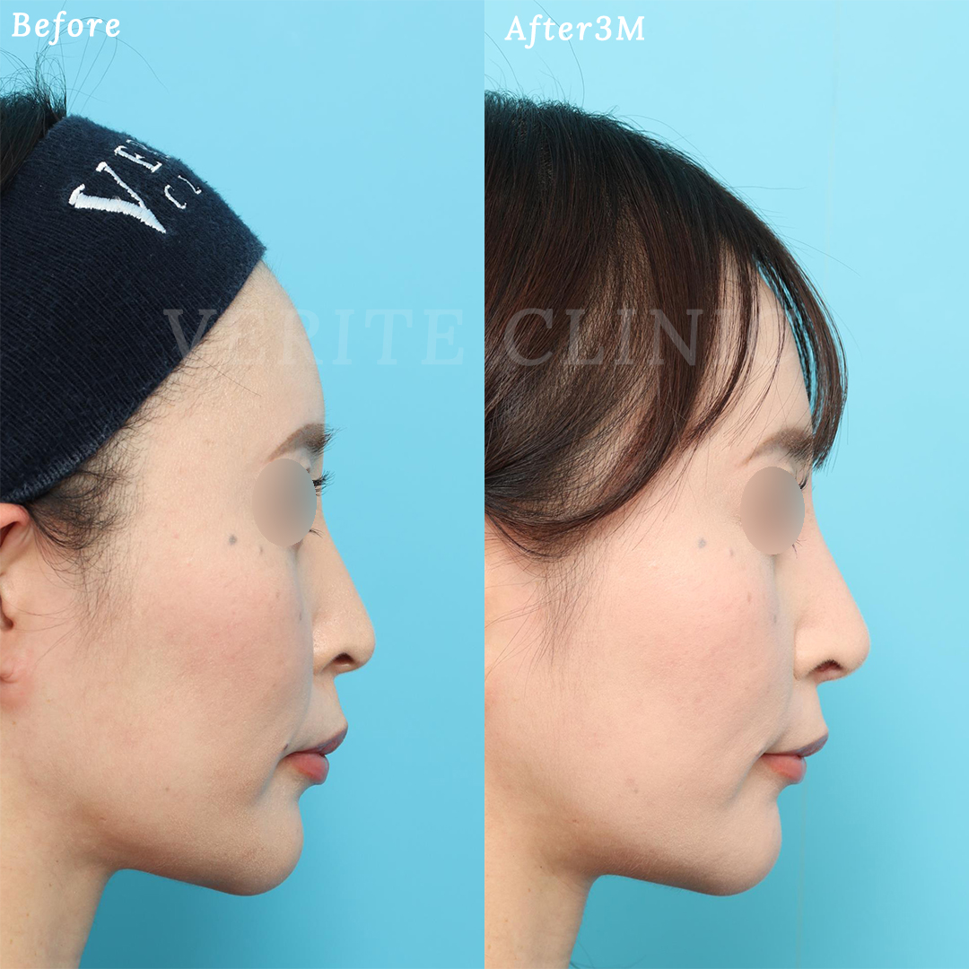 隆鼻術＋眉間プロテーゼの症例写真 (2) - サムネイル