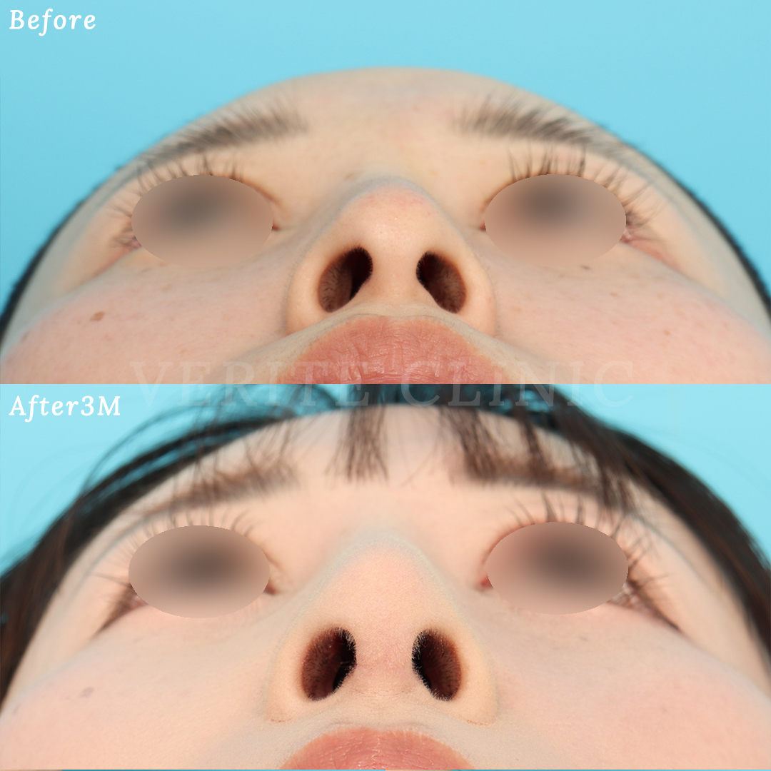 隆鼻術＋眉間プロテーゼの症例写真 (3) - サムネイル