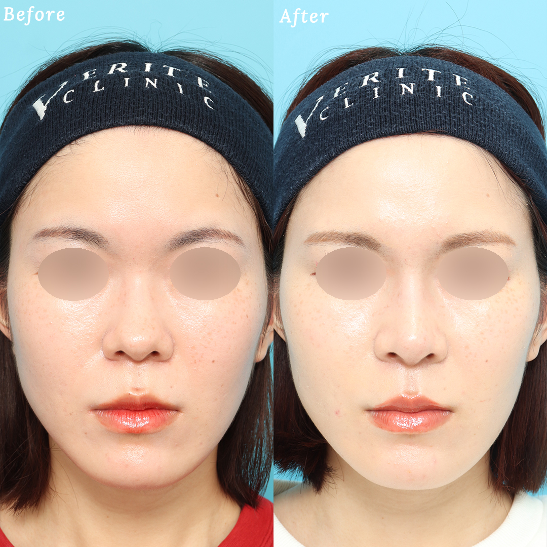 隆鼻術＋眉間プロテーゼの症例写真 (2) - サムネイル
