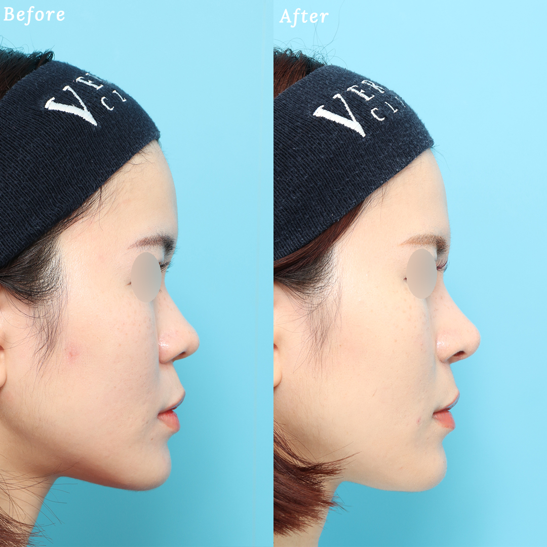 隆鼻術＋眉間プロテーゼの症例写真 (4) - サムネイル