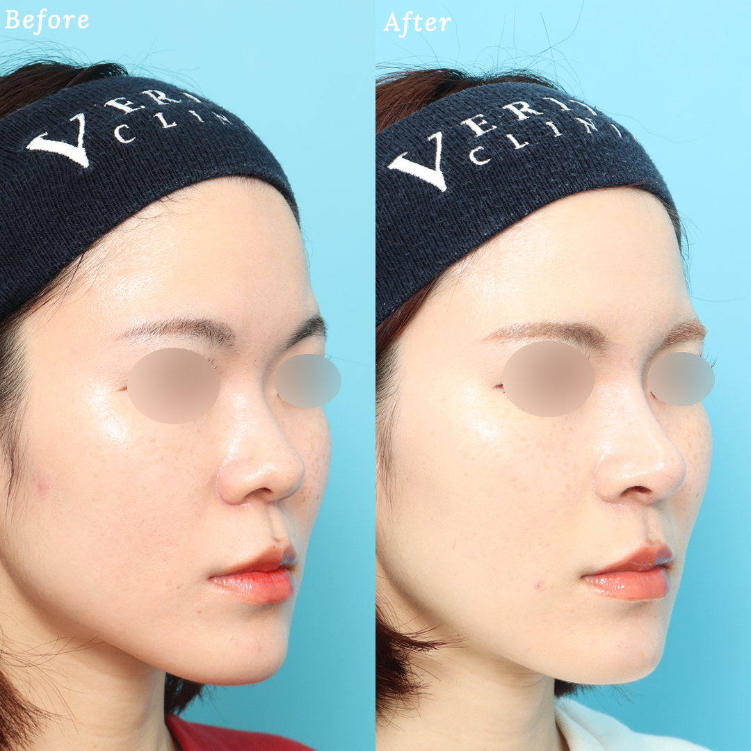 隆鼻術＋眉間プロテーゼの症例写真 (3) - サムネイル