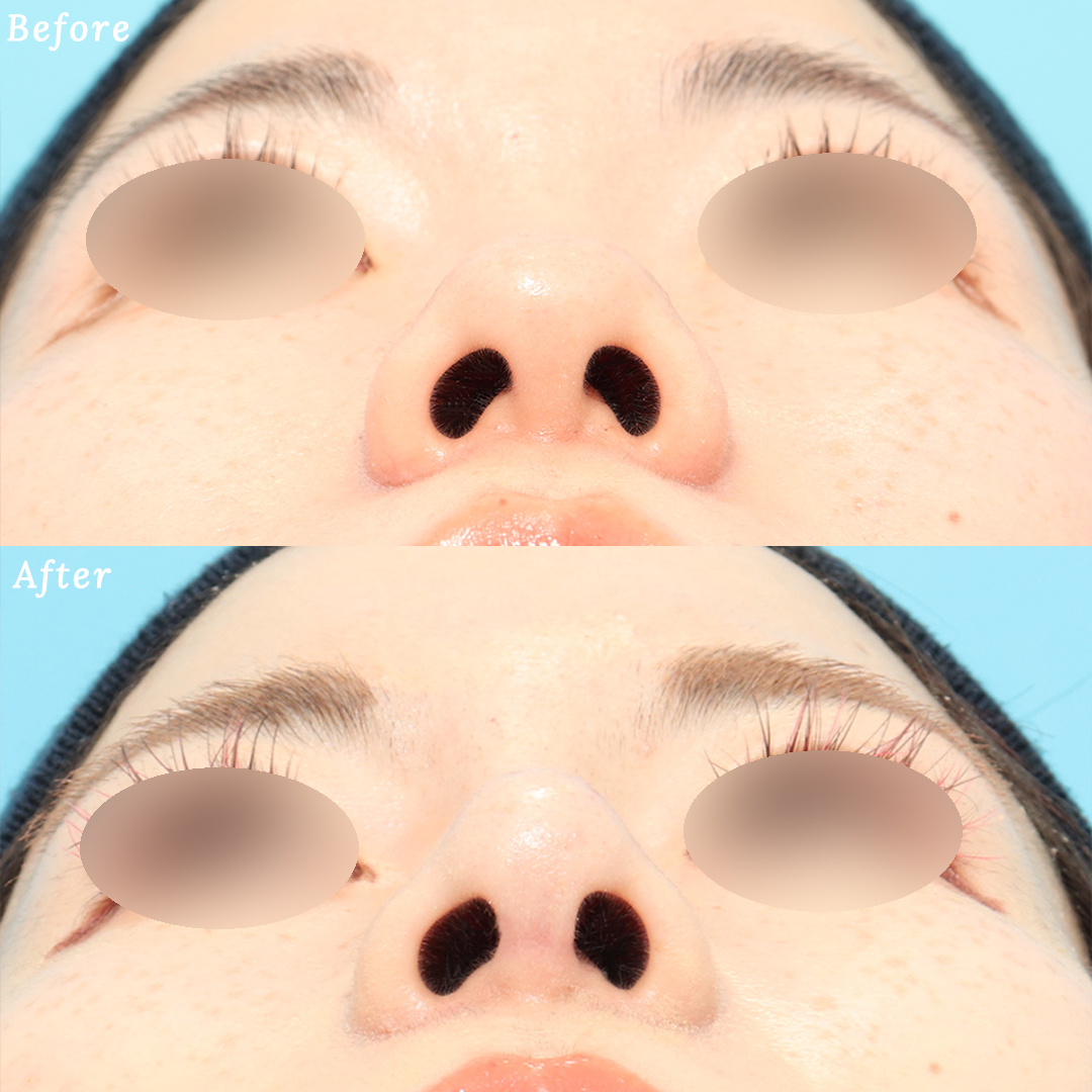 隆鼻術＋眉間プロテーゼの症例写真 (5) - サムネイル