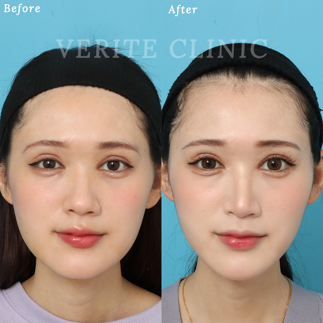 鼻尖形成＋鼻尖縮小の症例写真 (1) - サムネイル