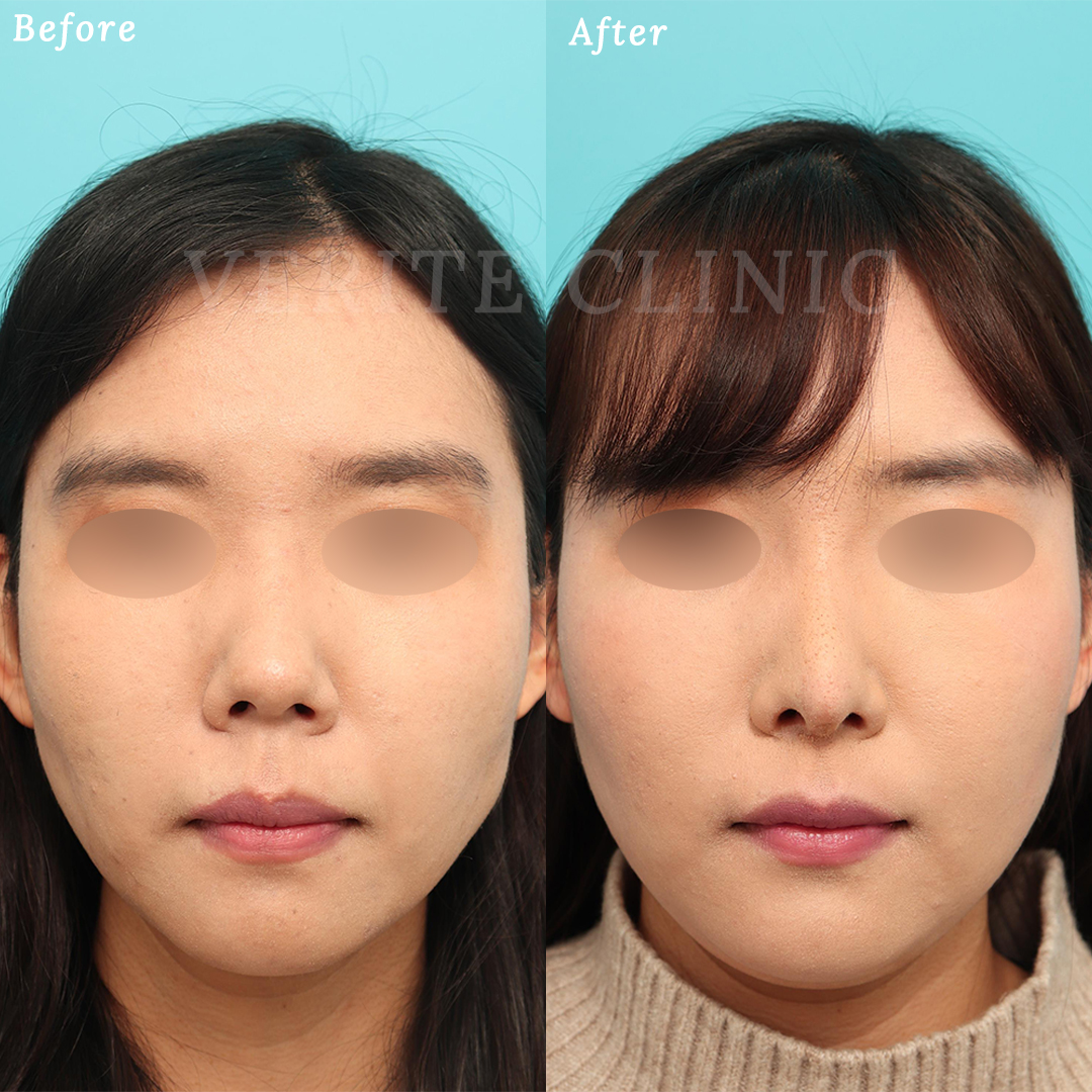 隆鼻術＋眉間プロテーゼの症例写真