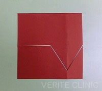 蒙古ひだの解剖