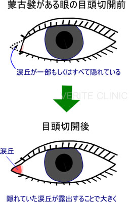 目頭切開