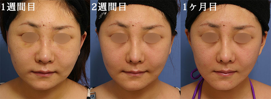 隆鼻術＋眉間プロテーゼの症例写真 (4) - サムネイル