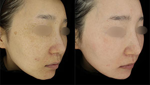 ゼオスキンヘルス（ZO SKIN HEALTH）の症例写真