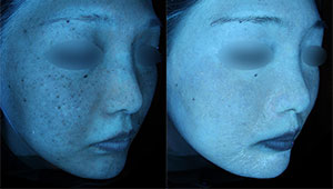 ゼオスキンヘルス（ZO SKIN HEALTH）の症例写真