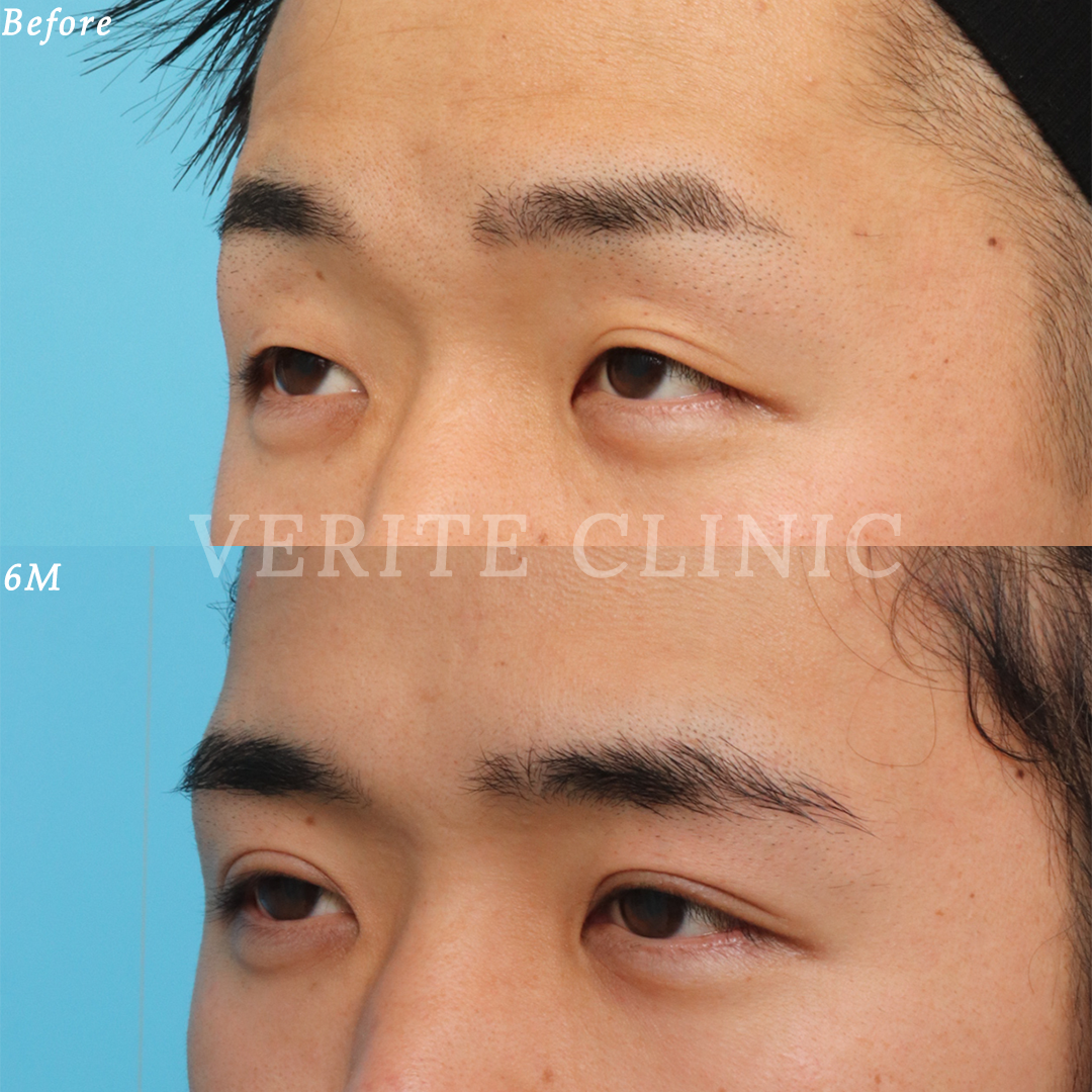 眼瞼下垂 | 美容整形・美容外科のヴェリテクリニック【公式】 東京