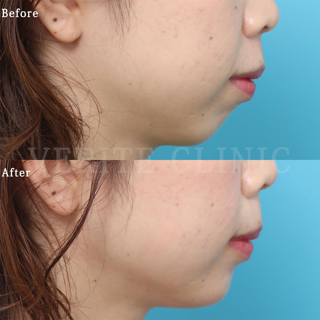 ボトックス注入 (シワ取り） | 美容整形・美容外科のヴェリテ