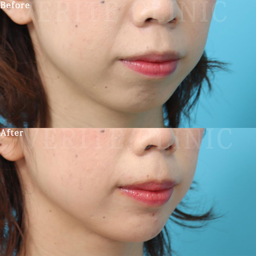 ボトックス注入 (シワ取り） | 美容整形・美容外科のヴェリテ