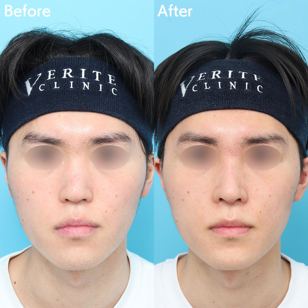 隆鼻術＋眉間プロテーゼの症例写真 (3)