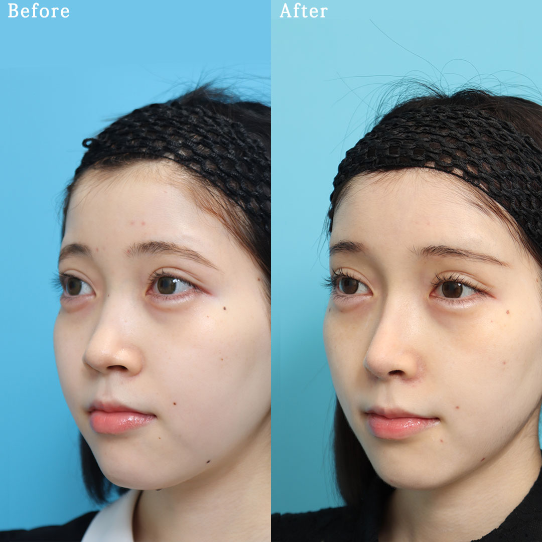 鼻骨骨切り幅寄せ術の症例写真 (2) - サムネイル