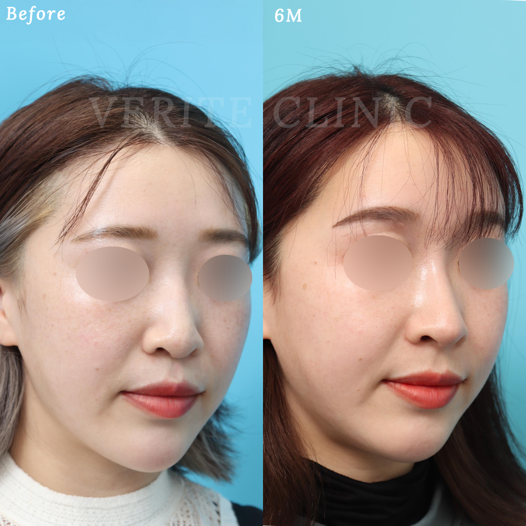 隆鼻術＋眉間プロテーゼの症例写真 (2) - サムネイル