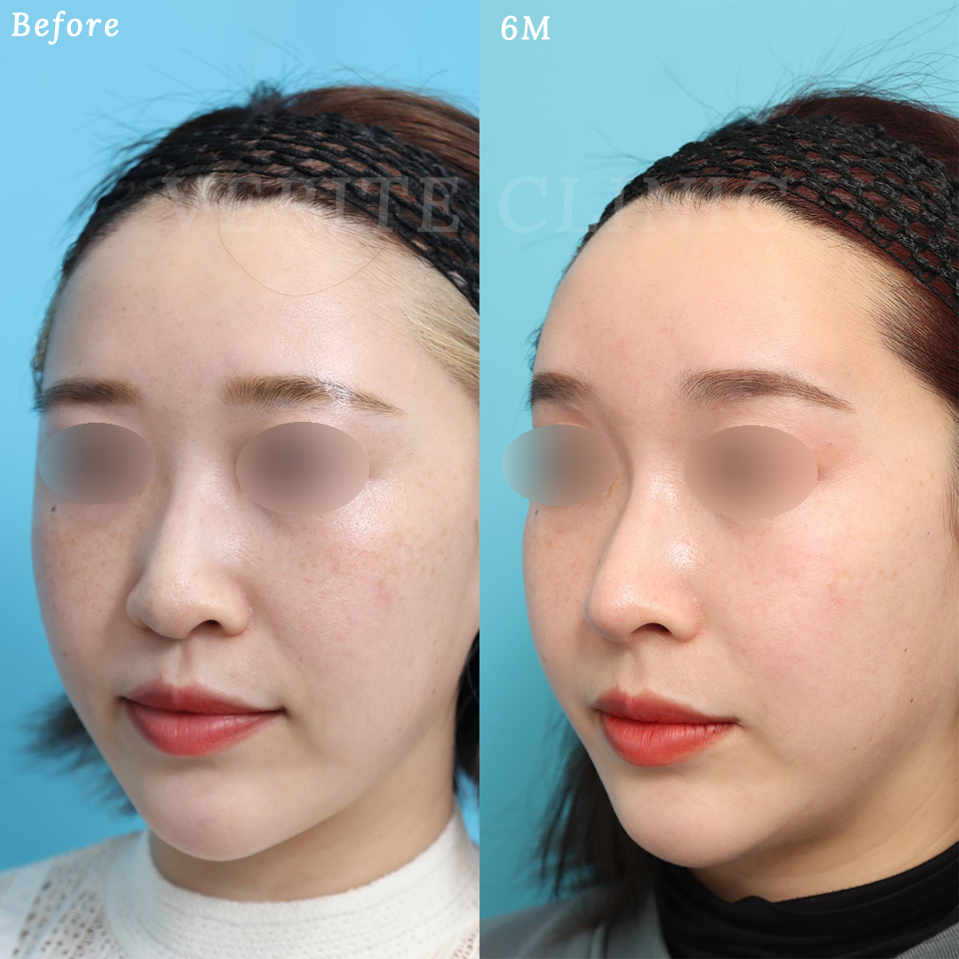 隆鼻術＋眉間プロテーゼの症例写真 (3) - サムネイル