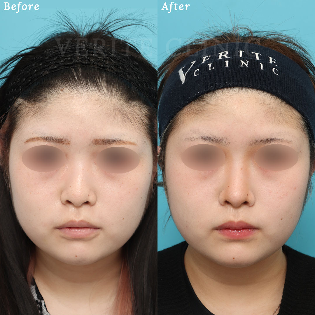 鼻尖形成＋鼻尖縮小の症例写真 (2) - サムネイル