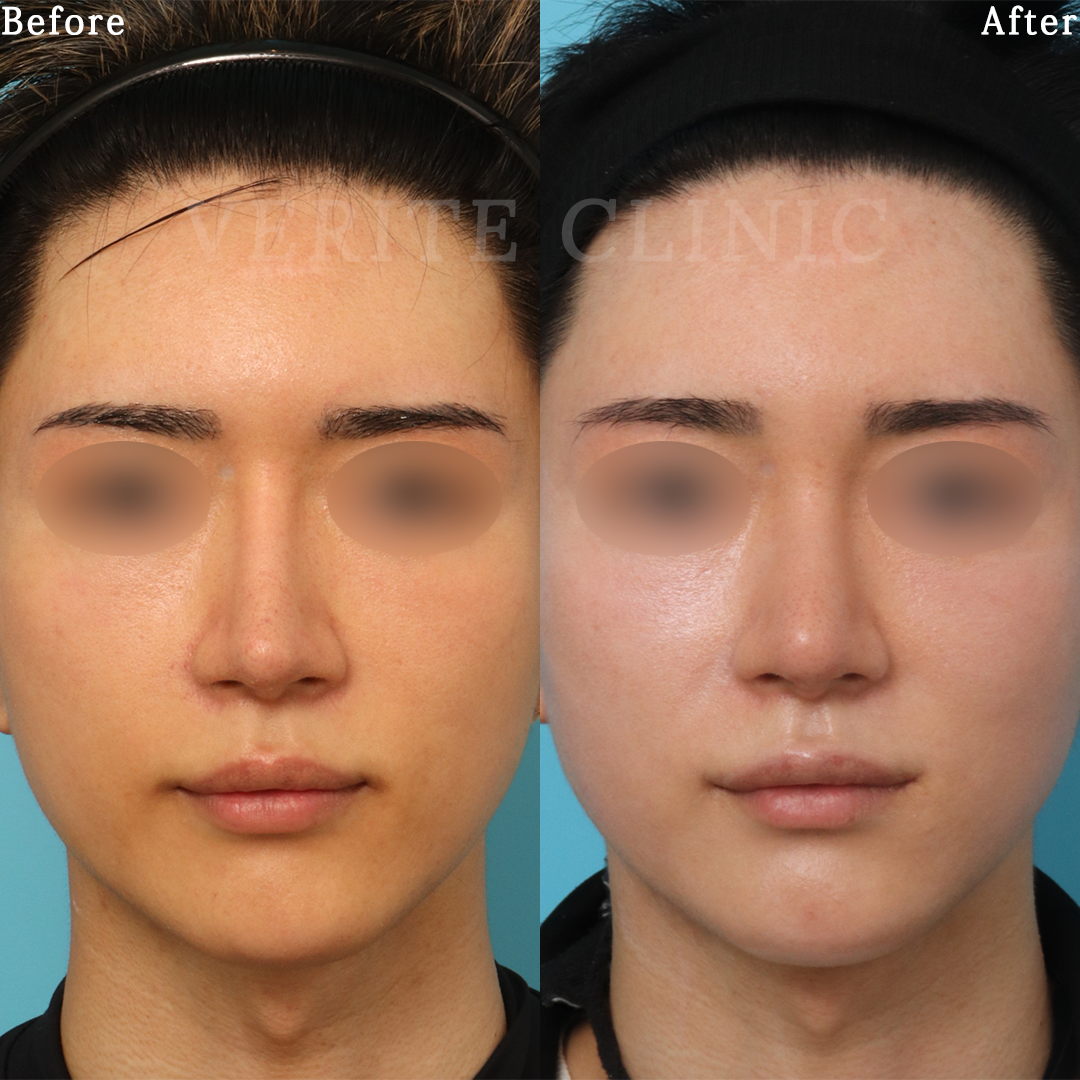 隆鼻術＋眉間プロテーゼの症例写真
