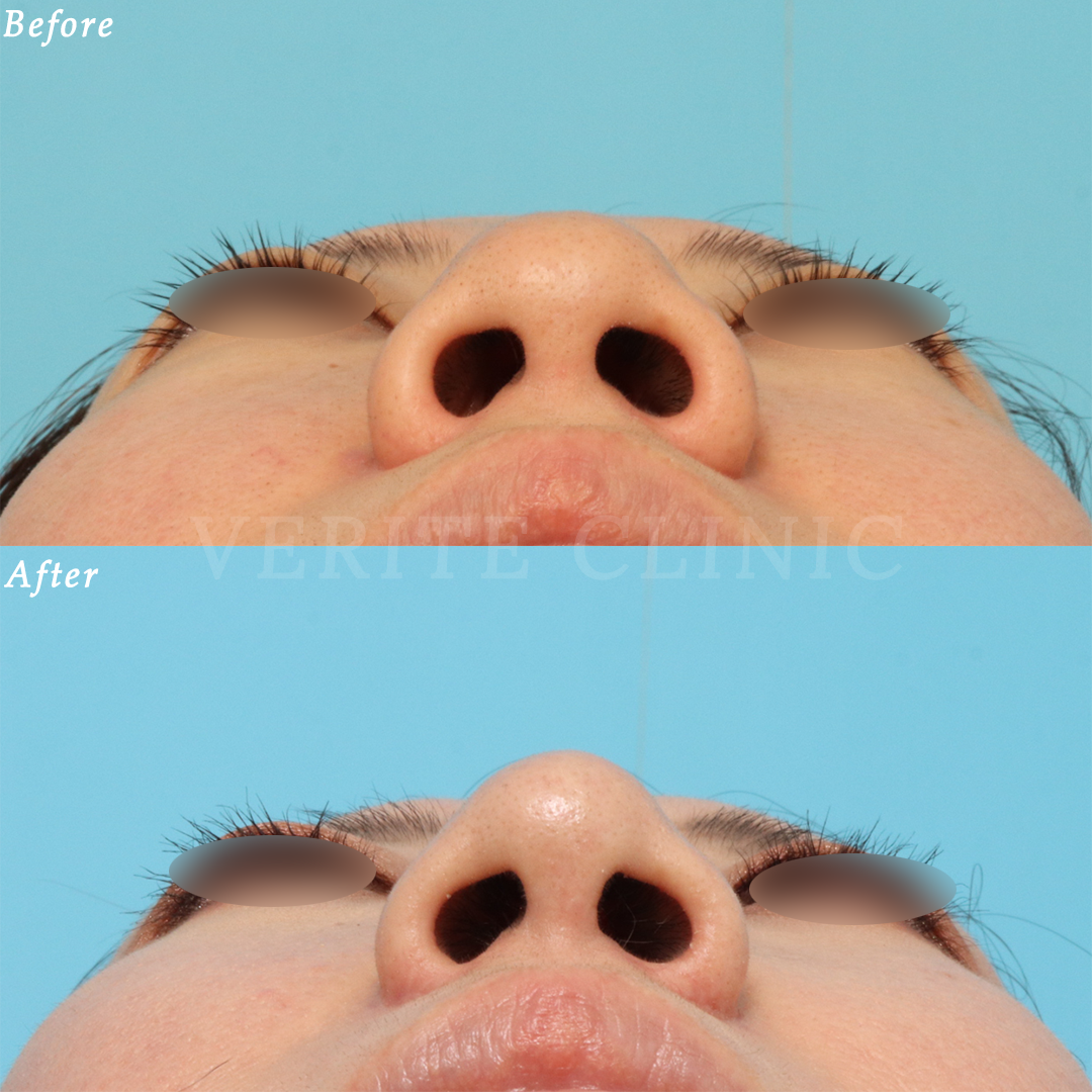 鼻尖縮小術の症例写真 (3) - サムネイル