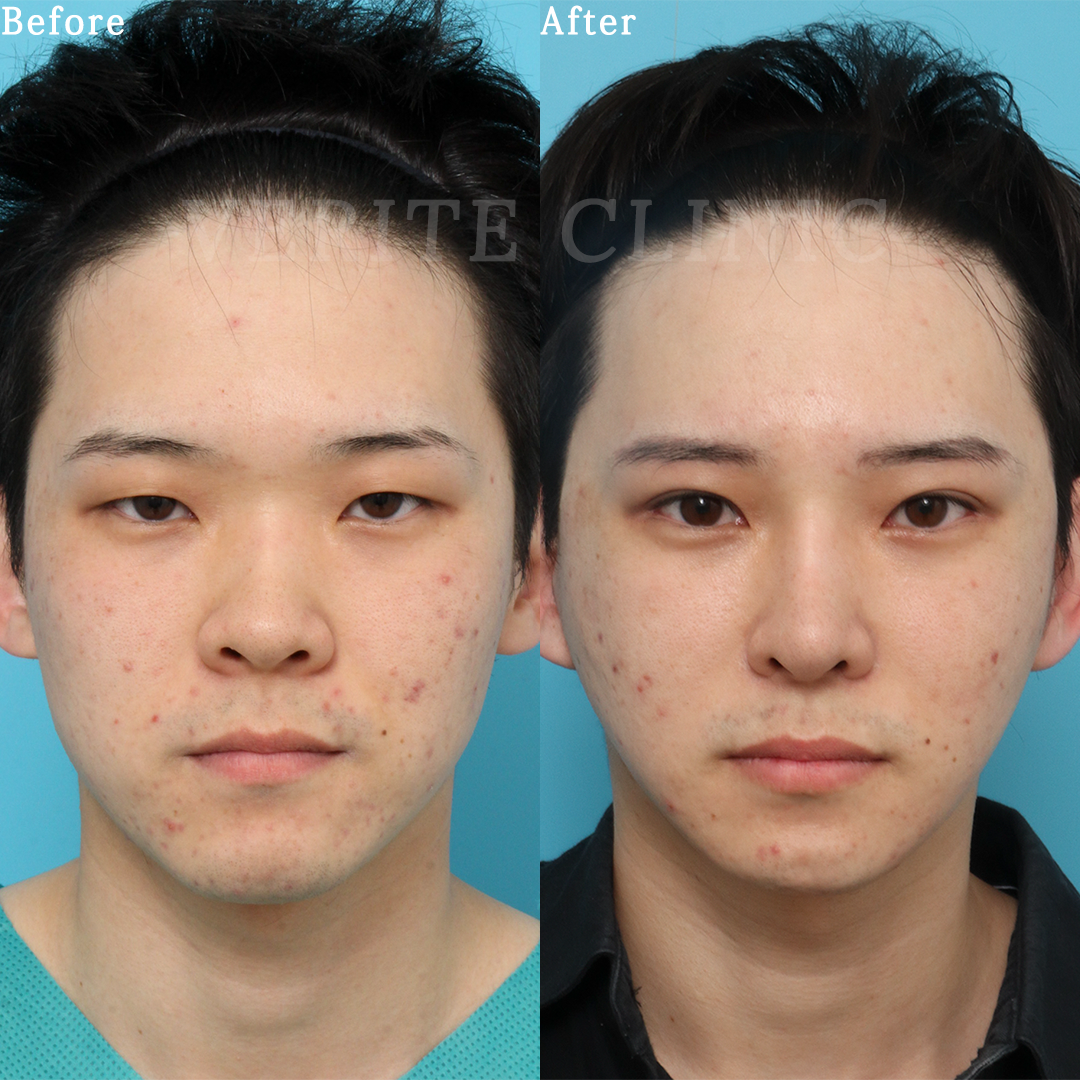 鼻中隔延長術＋肋軟骨移植術の症例写真