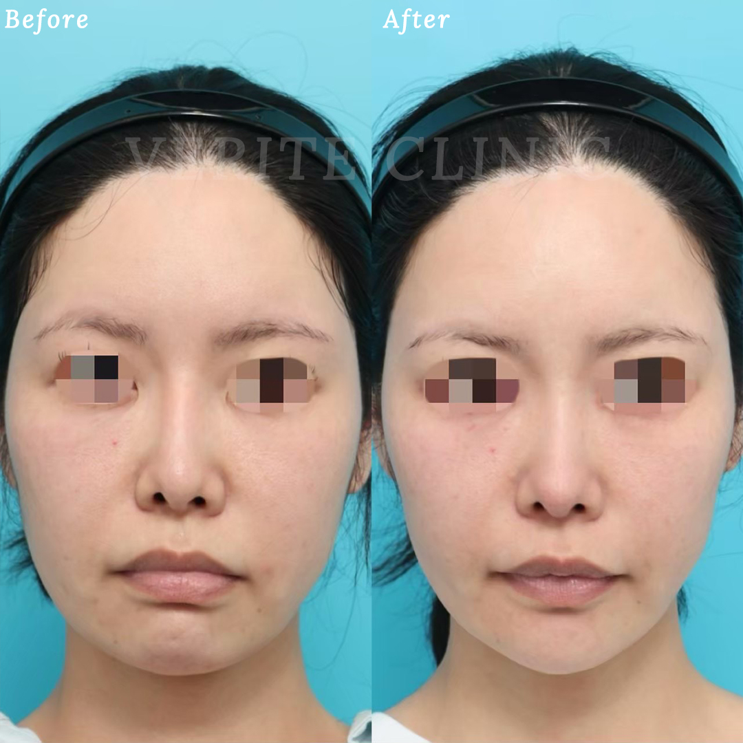 隆鼻術＋眉間プロテーゼの症例写真 (2)