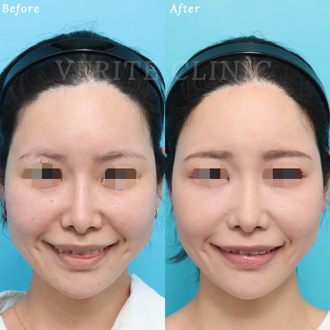 隆鼻術＋眉間プロテーゼの症例写真 (6)