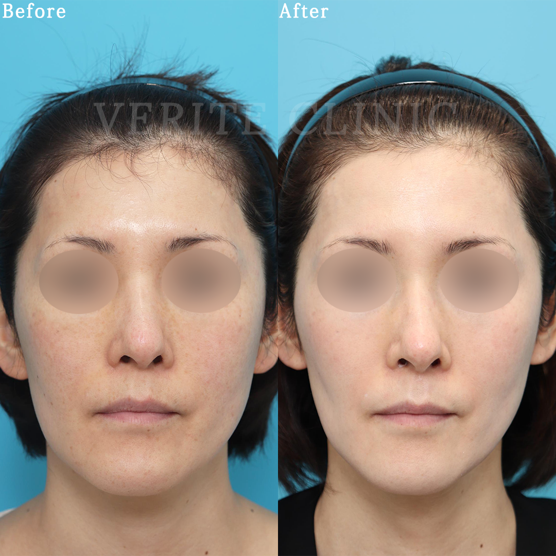 ゼオスキンヘルス（ZO SKIN HEALTH）の症例写真