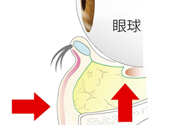 目袋プッシュバック