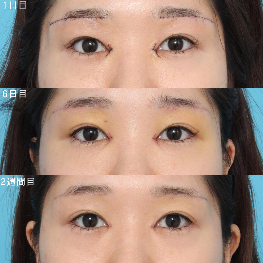 上眼瞼リフト（眉下切開）の症例写真 (2) - サムネイル