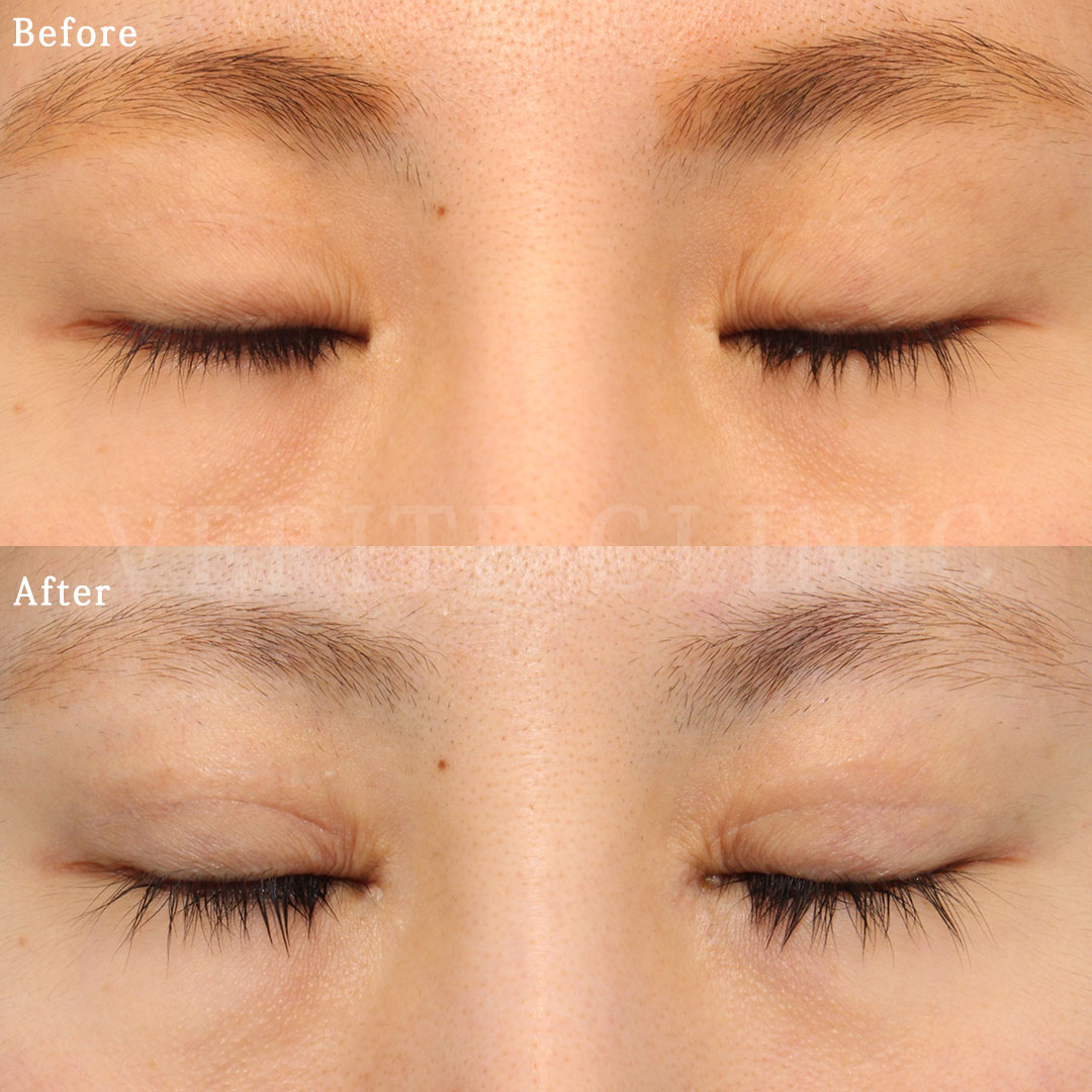 二重の他院修正】広くしすぎた二重幅を狭くしてナチュラルなぱっちり目