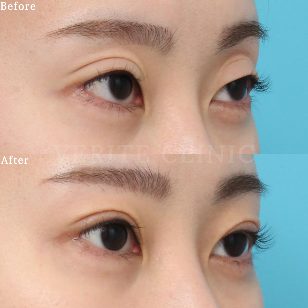 眼瞼下垂 | 美容整形・美容外科のヴェリテクリニック【公式】 東京