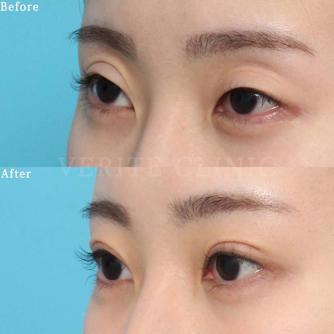 眼瞼下垂 | 美容整形・美容外科のヴェリテクリニック【公式】 東京