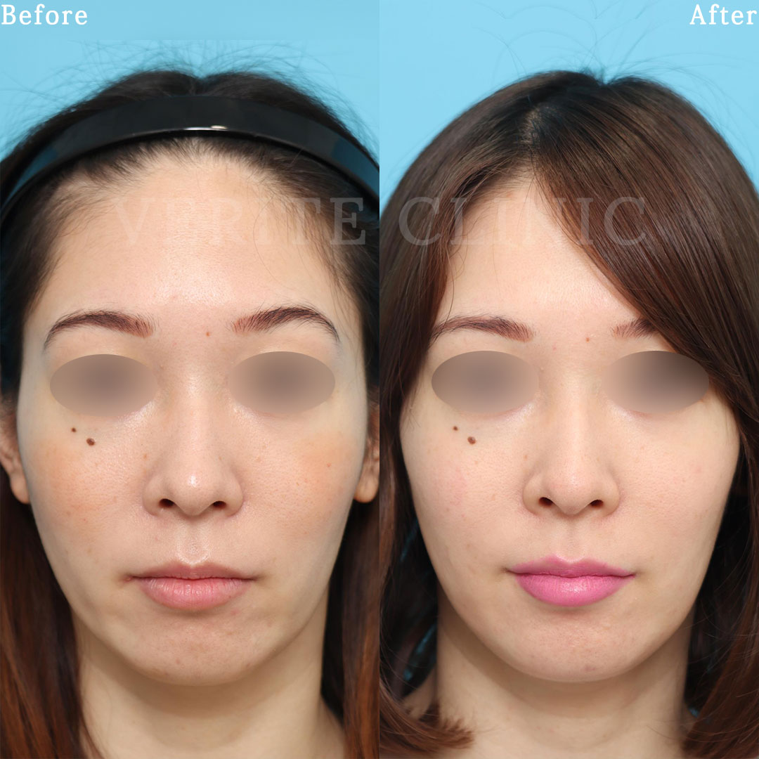 ボトックス注入 (シワ取り） | 美容整形・美容外科のヴェリテ