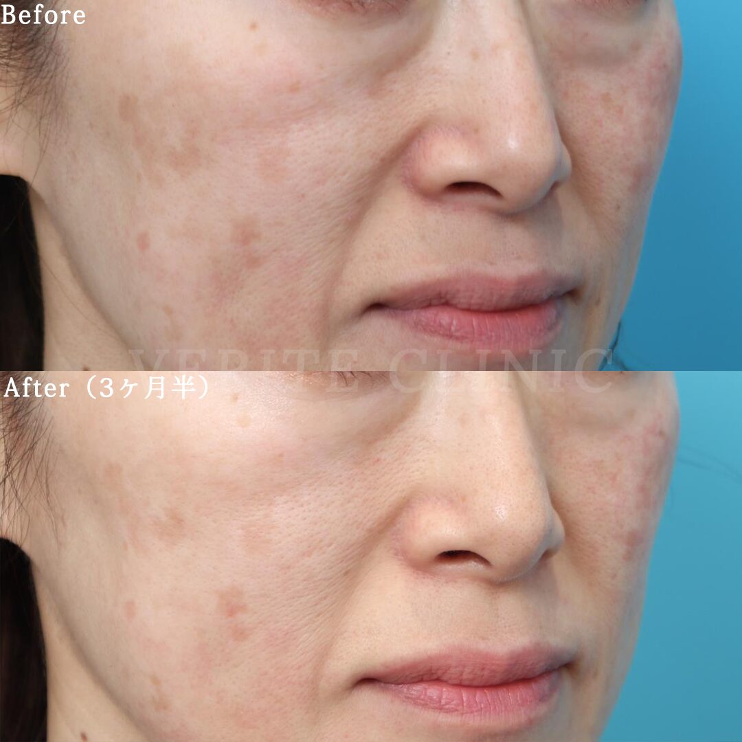 デイリーPD・バランサートナー・ミラミン・スキンブライセラムでシミ