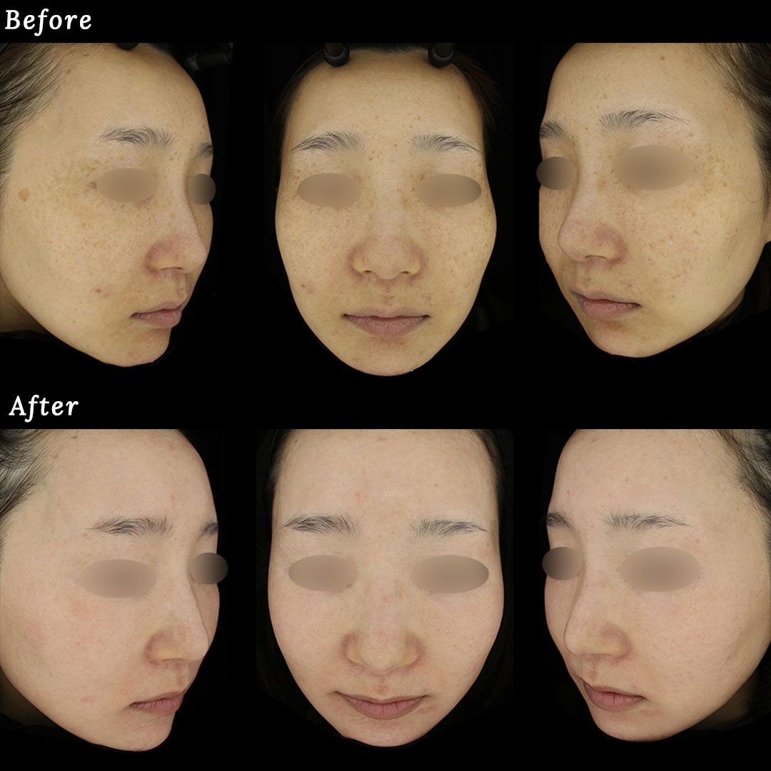 ゼオスキンヘルス（ZO SKIN HEALTH）の症例写真