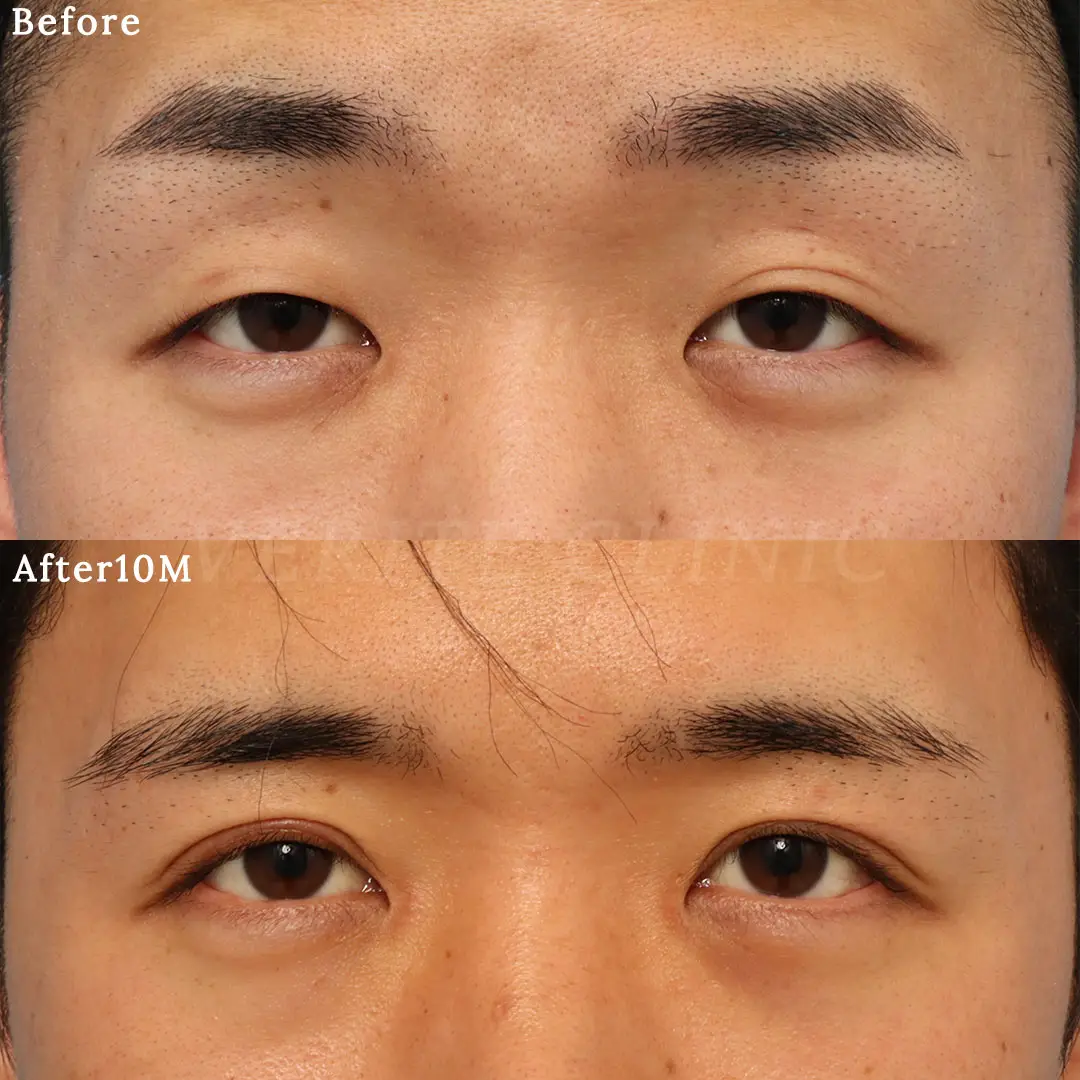 眼瞼下垂の症例写真 | 積山 真也医師 | 美容整形・美容外科のヴェリテ