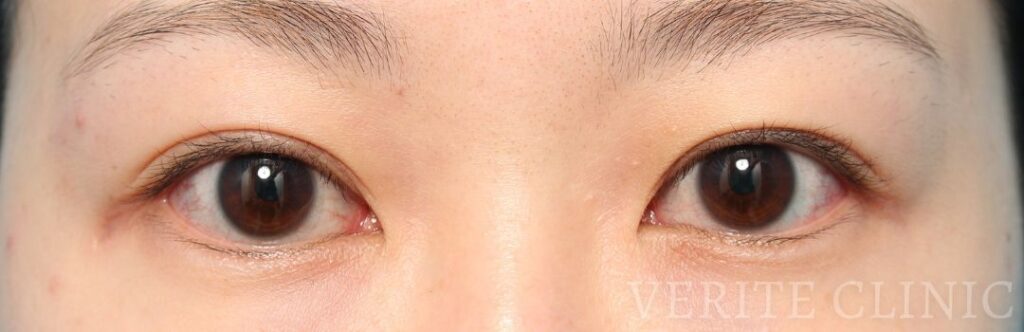 二重ラインが二股に分かれて見える例①