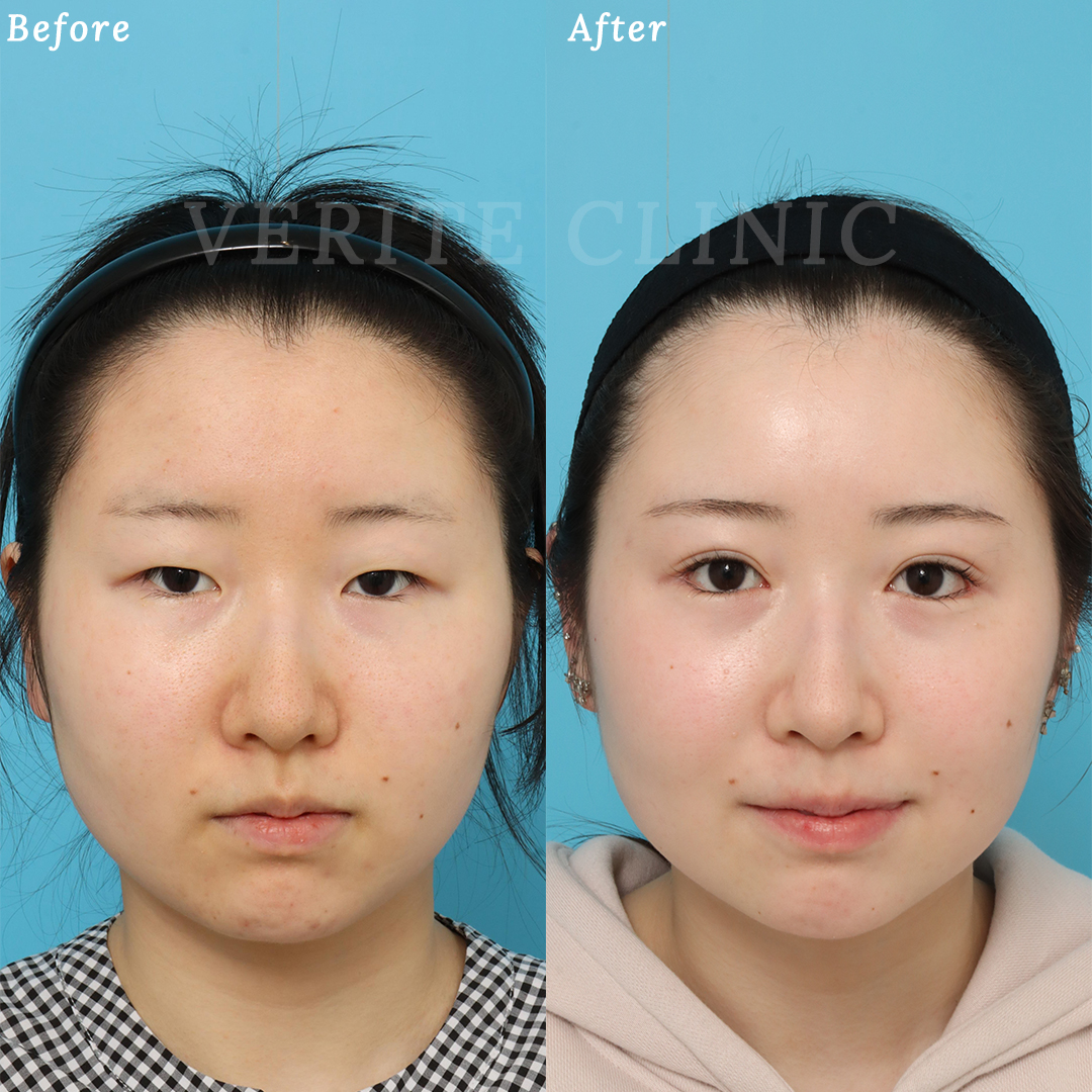 雌雄眼をナチュラルな平行二重へ| 美容整形・美容外科のヴェリテ