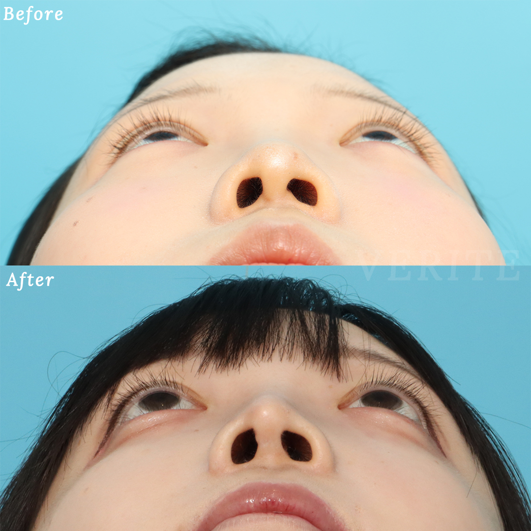 頬骨セットバックのビフォーアフターの症例画像（あおり）