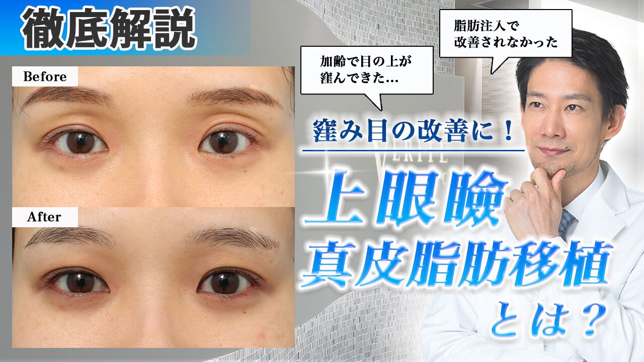 上眼瞼真皮脂肪移植を鈴木医師が解説！上まぶたの窪み（窪み目）がお