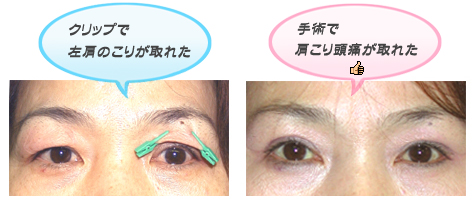 眼瞼下垂の手術によって頭痛や肩凝りが改善