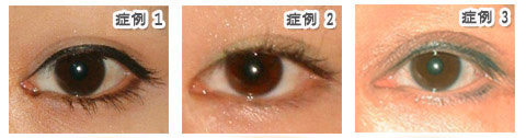 目頭切開:違和感