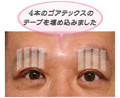 4本のゴアテックスのテープを埋め込む